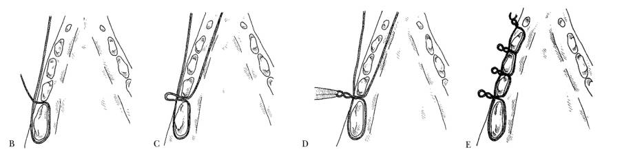 op_-_interdental_wiring_1_holmstrom_2007_.jpg op_-_interdental_wiring_1_holmstrom_2007_.jpg