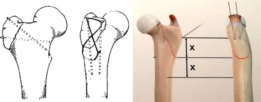 op_-_femurfraktur_-_avulsion_trochanter_mayor_piermattei_2017_.jpg op_-_femurfraktur_-_avulsion_trochanter_mayor_piermattei_2017_.jpg