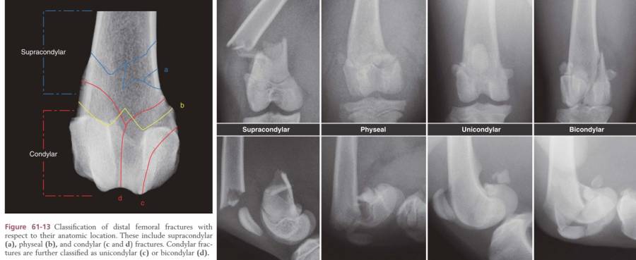 op_-_femurfraktur_-_distale_femurfraktur_klassifizierung_tobias_2012_.jpg op_-_femurfraktur_-_distale_femurfraktur_klassifizierung_tobias_2012_.jpg