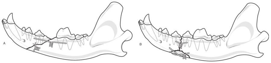 op_-_unterkieferfraktur_cerclage_2_tobias_johnston_2012_.jpg op_-_unterkieferfraktur_cerclage_2_tobias_johnston_2012_.jpg