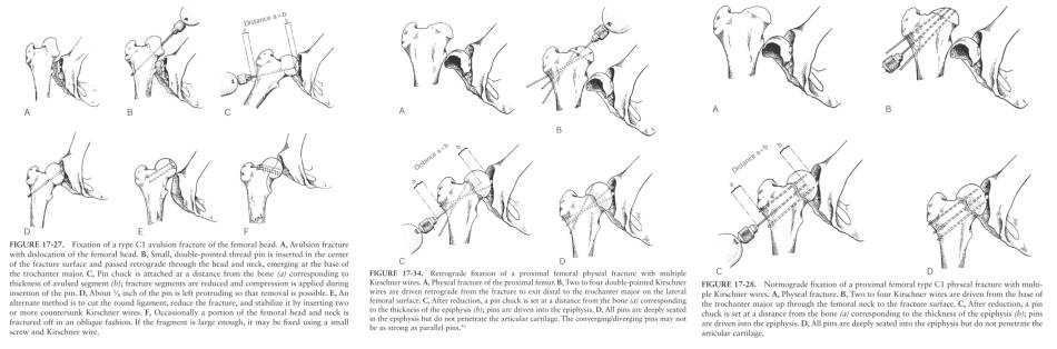 op_-_femurfraktur_-_proximale_femurkopffrakturen_piermattei_2017_.jpg op_-_femurfraktur_-_proximale_femurkopffrakturen_piermattei_2017_.jpg