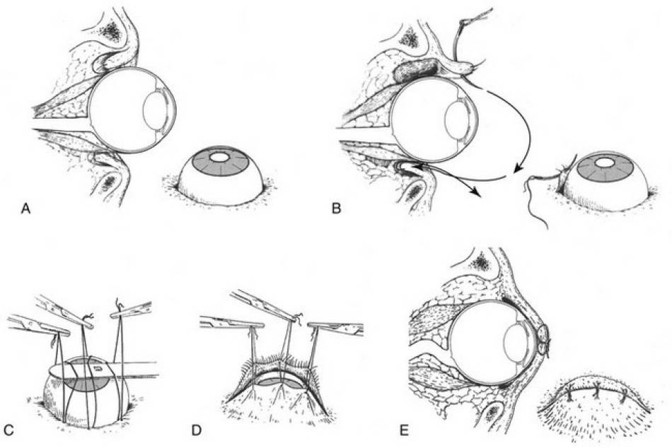 ophthalmologie_op_-_tarsoraphie_quelle_unbekannt_.jpg ophthalmologie_op_-_tarsoraphie_quelle_unbekannt_.jpg