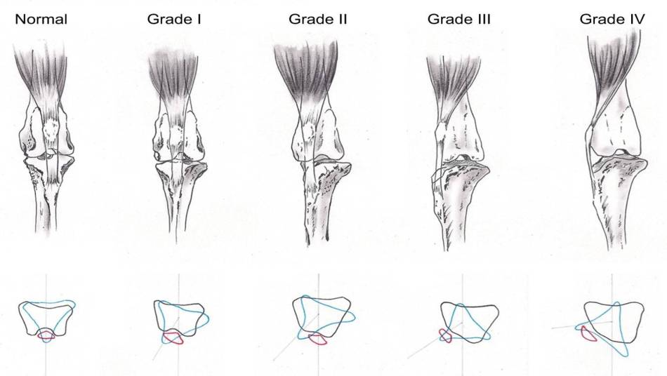 patellaluxation_grade_di_dona_et_al._2018_.jpg patellaluxation_grade_di_dona_et_al._2018_.jpg